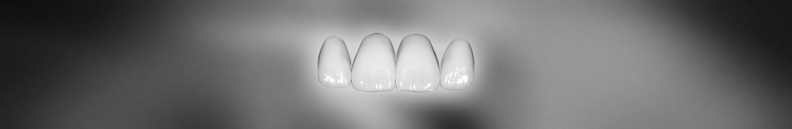 Veneers
